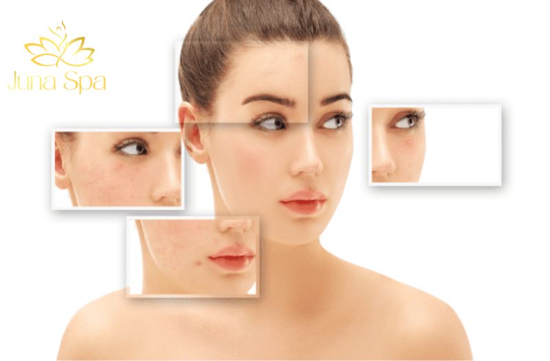 Sẹo lõm là gì? Nguyên nhân và cách điều trị sẹo lõm