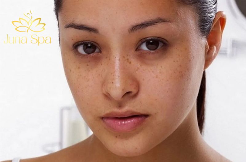 dấu hiệu nhân biết bớt Hori