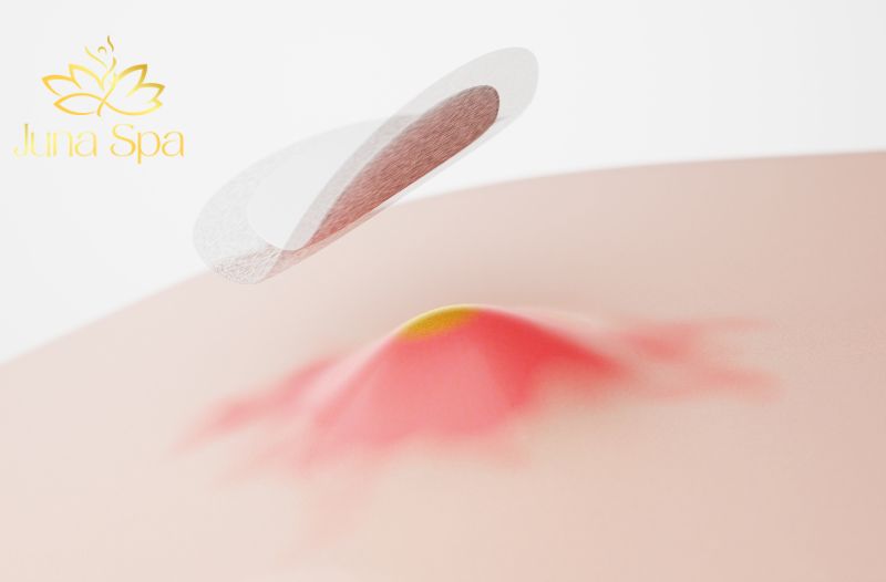 trị mụn bằng tỏi