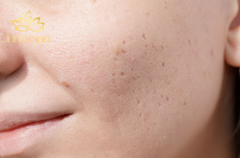 Sẹo lõm có tự đầy được không