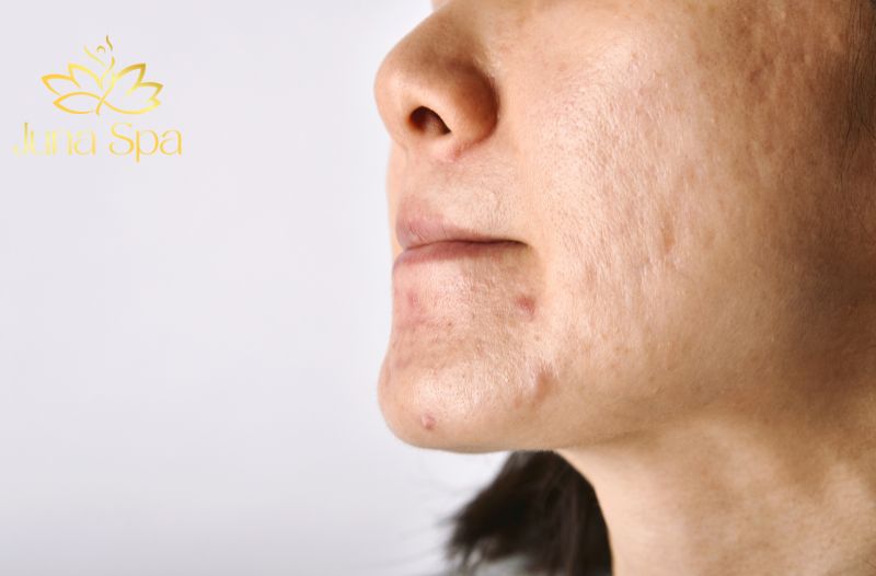 Cách điều trị sẹo lõm hiệu quả