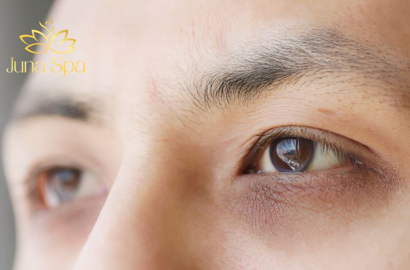 Quầng thâm và bọng mắt