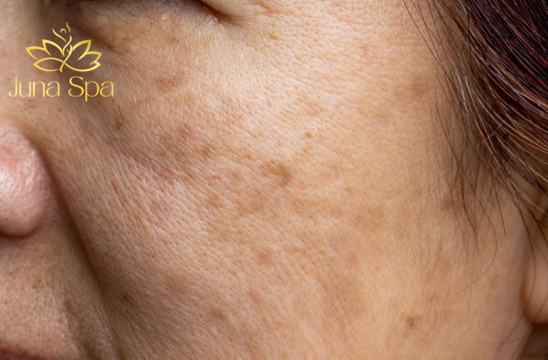 sắc tố gây ra nám da