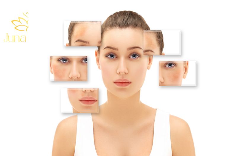 các giai đoạn của nám da