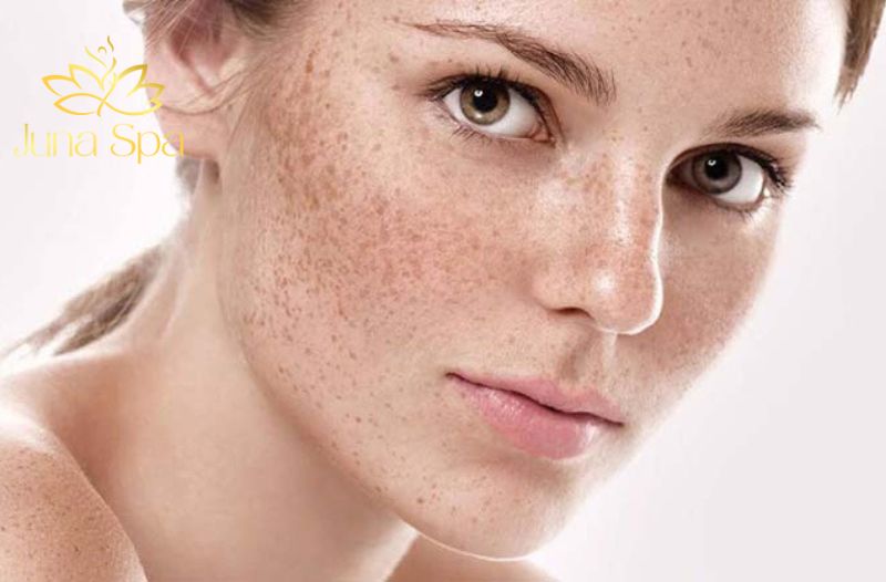 nám cánh bướm là gì