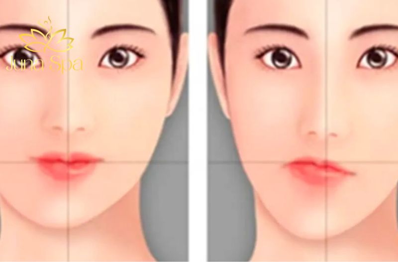 mặt lệch do bẩm sinh