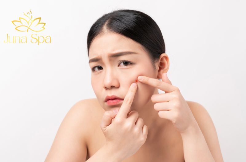 Tại sao không nên tự nặn mụn
