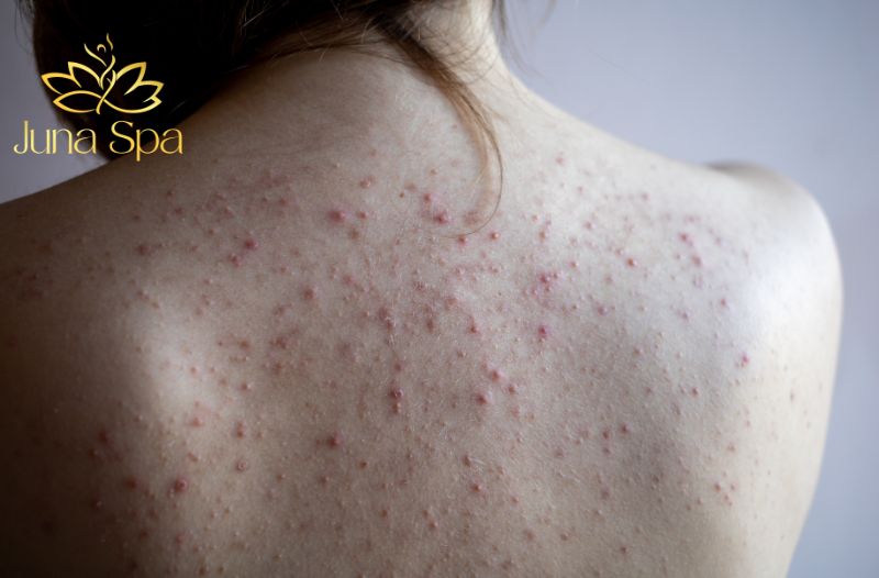 nguyên nhân dẫn đến mụn lưng