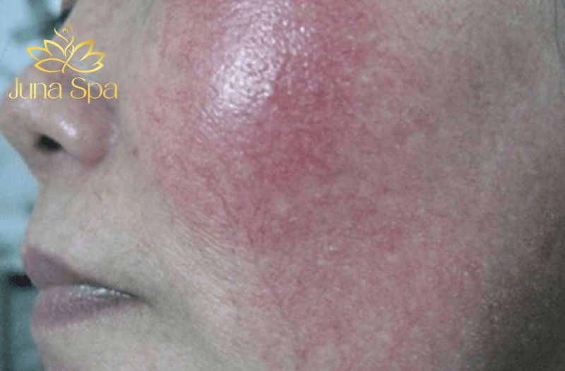 da nhiễm corticoid