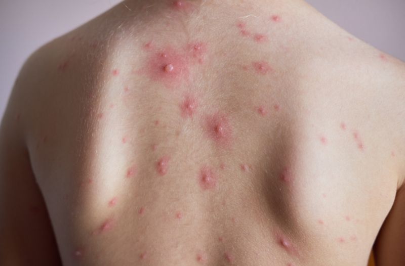 các nguyên nhân dẫn đến mụn lưng