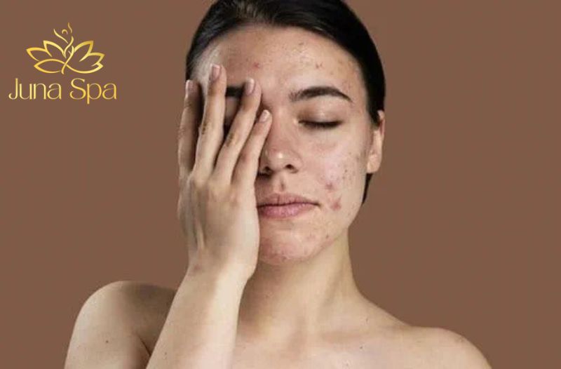 Dấu hiệu nhận biết da bị nhiễm corticoid