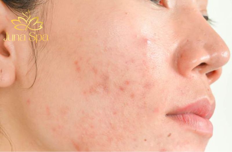 Chăm sóc da đúng cách khi bị nhiễm corticoid