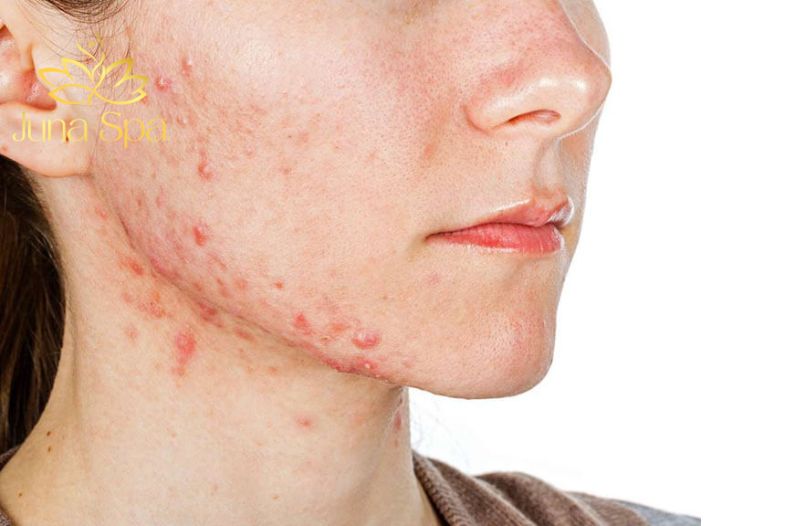 Biện pháp phòng ngừa da nhiễm corticoid