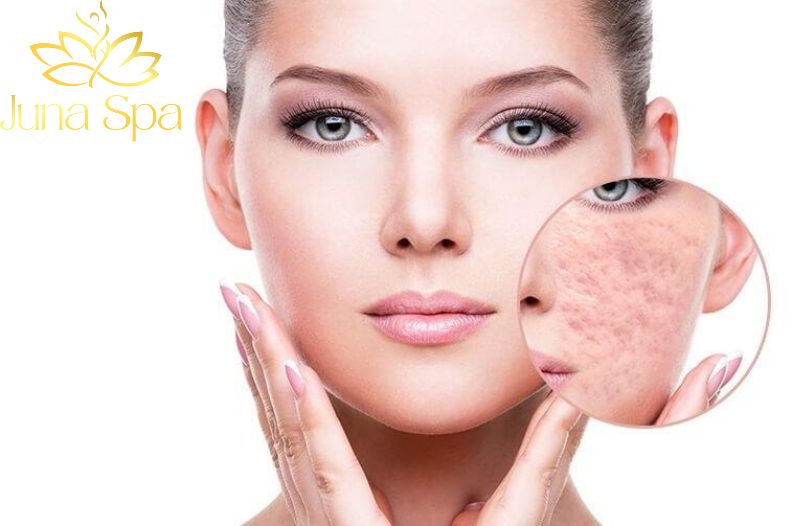 Các phương pháp trị sẹo rỗ chuẩn y khoa