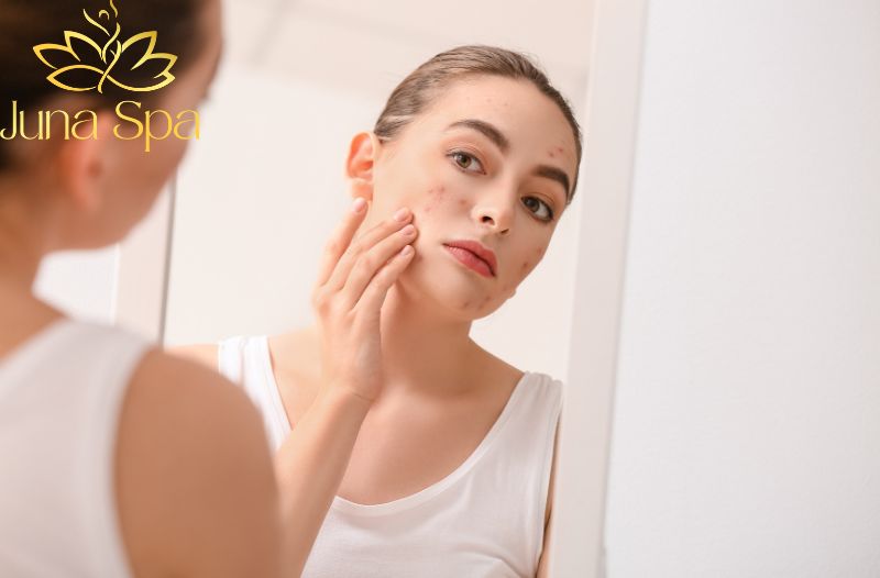 Mụn tái đi tái lại do không loại bỏ được gốc nhân mụn