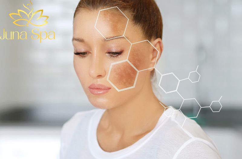 Tàn nhang không có cách trị