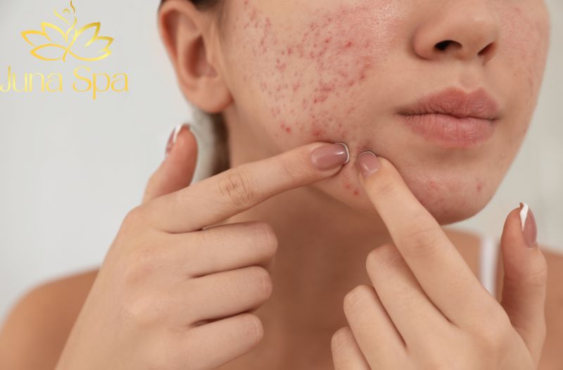 Viêm nhiễm da do tự nặn mụn không đúng cách
