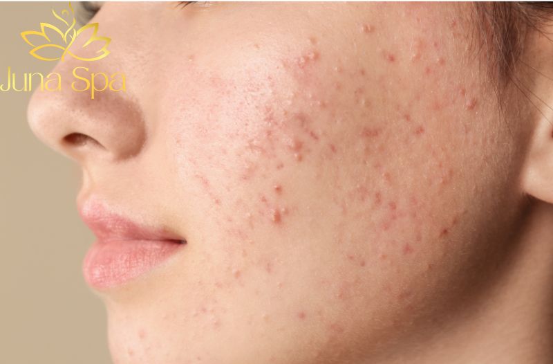 Hệ quả của việc sử dụng corticoid không đúng cách