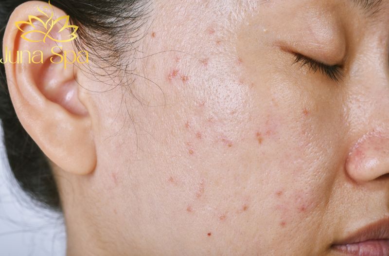 Phương pháp trị mụn mủ an toàn và hiệu quả