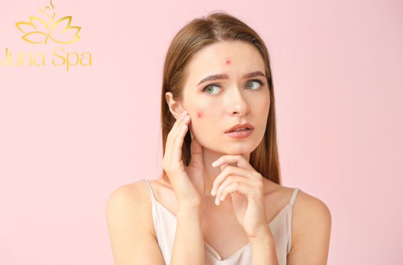 Phân biệt mụn do nội tiết, nóng gan hay skincare sai cách