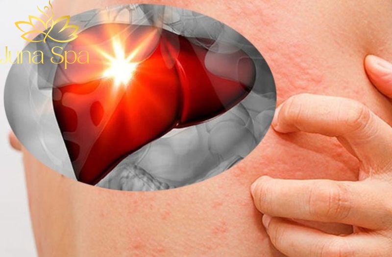 Mụn do nóng gan