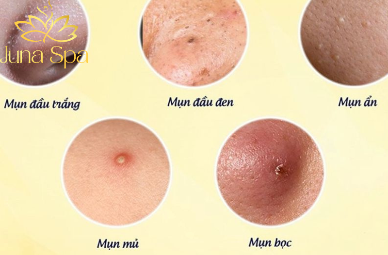 Các loại mụn thường gặp và cách nhận biết