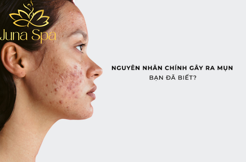 Các yếu tố ảnh hưởng đến quá trình trị mụn