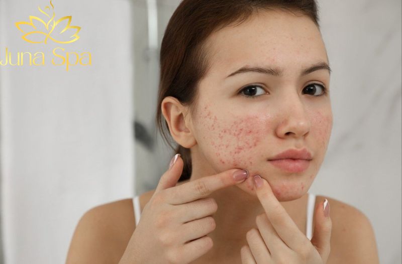 mụn trứng cá đảo ngược