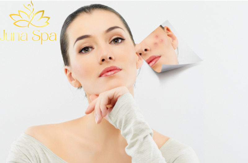Lưu ý và chăm sóc da sau trị mụn
