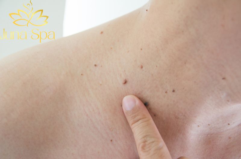 5 tác nhân gây ra tình trạng mụn cóc và cách phòng ngừa