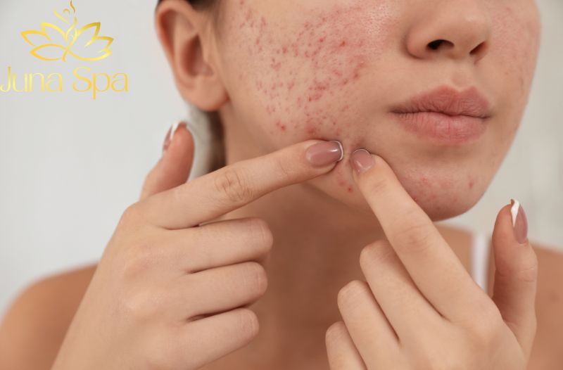 mụn xuất hiện nhiều và kéo dài