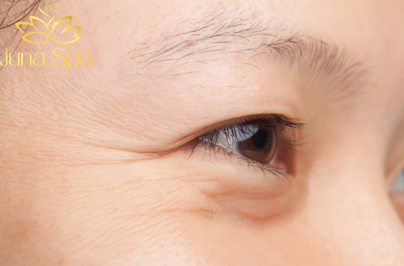Vết nhăn khóe mắt