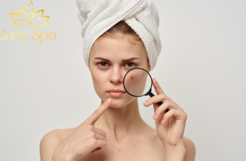 Hiểu rõ về mụn ẩn lâu năm