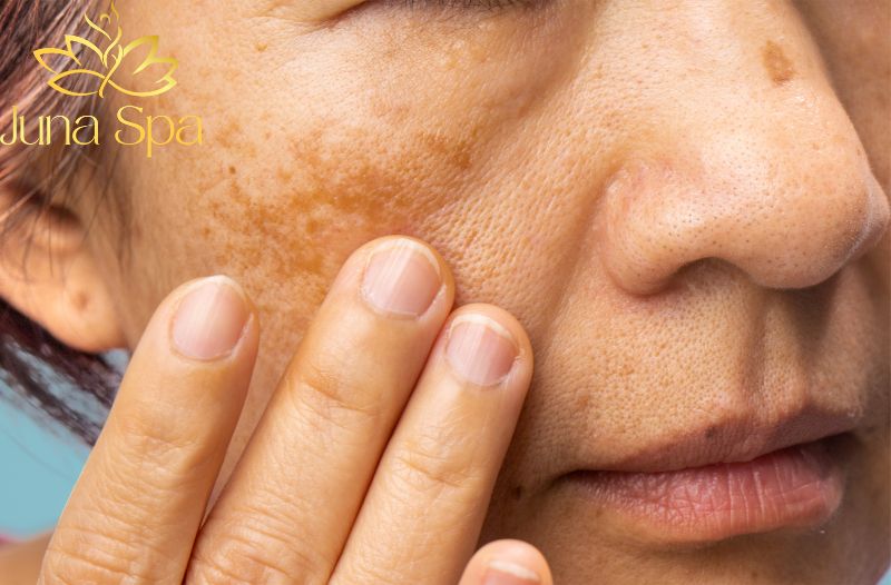 Cách nhận biết nám hỗn hợp