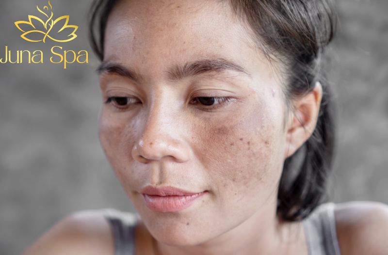 Nguyên nhân hình thành nám hỗn hợp