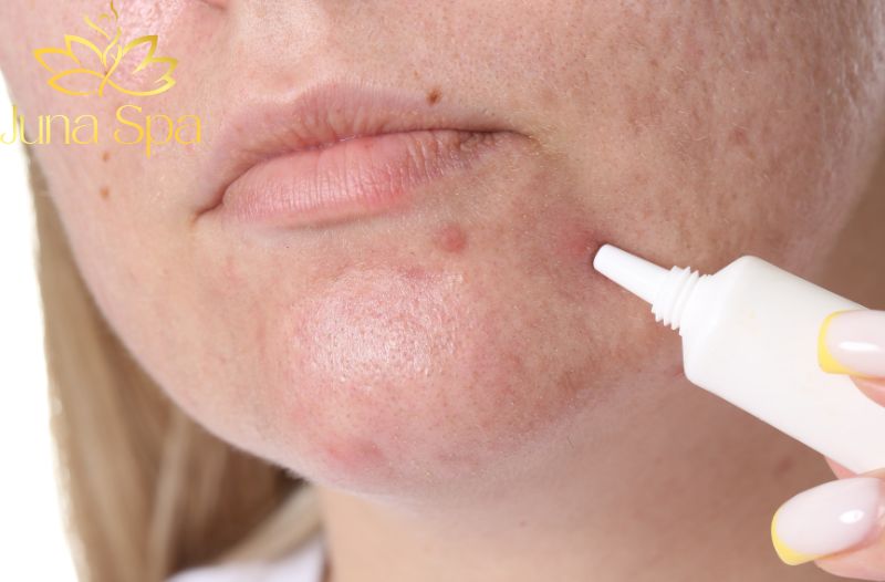 Nguy hiểm của mụn viêm nếu không xử lý đúng cách