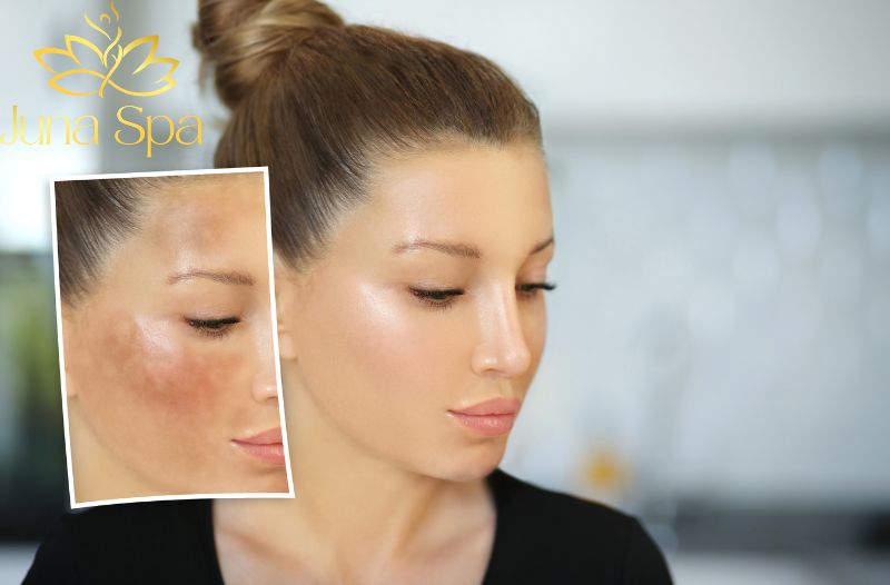 Chiến lược chăm sóc nám hỗn hợp hiệu quả