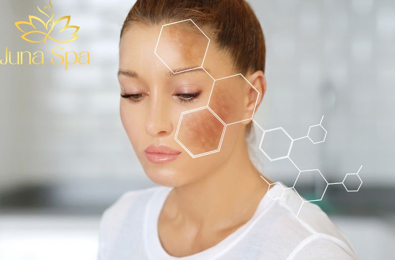 Vì sao nên chăm sóc nám hỗn hợp tại spa