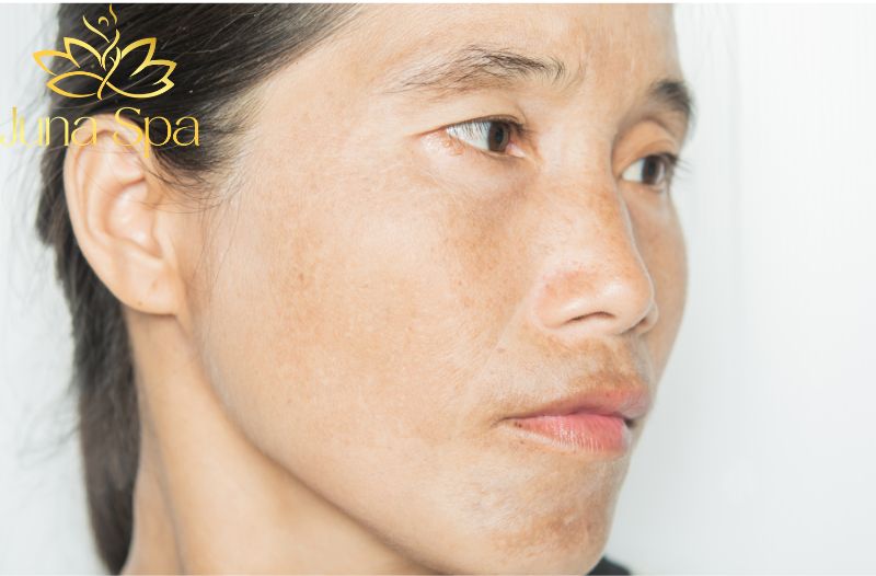 Những yếu tố khiến nám do nắng trở nên nghiêm trọng hơn