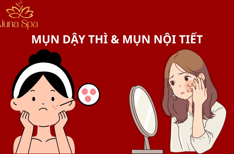 Mụn dậy thì và mụn nội tiết tố khác nhau như thế nào? Cách chăm sóc da khi xuất hiện mụn