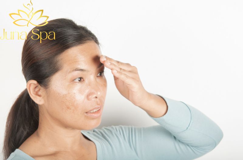 Nguyên nhân gây nám da ngoài ánh nắng và cách phục hồi làn da sáng mịn tự nhiên