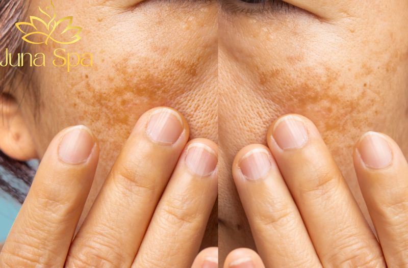 Vì sao nám có thể tái phát sau Laser CO₂ Fractional