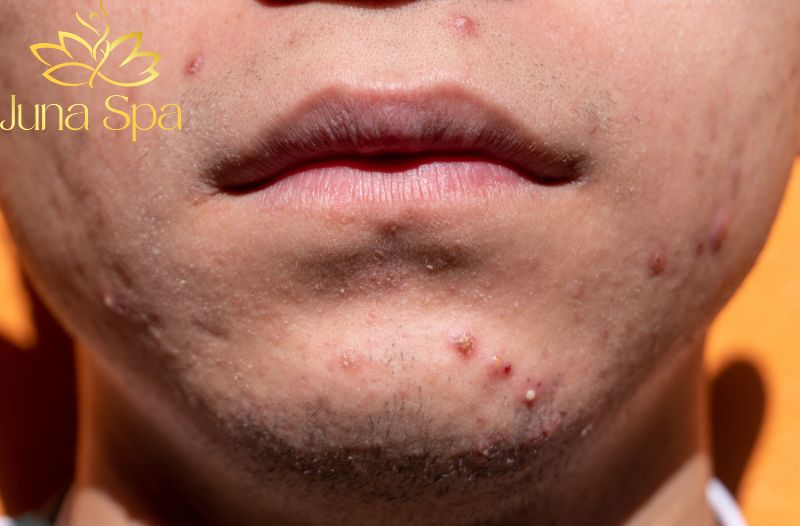 Da nổi mụn do trang điểm thường xuyên và ăn uống thiếu lành mạnh