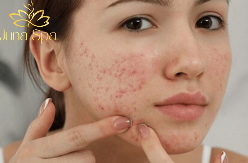 Cách trị mụn trứng cá dạng nang