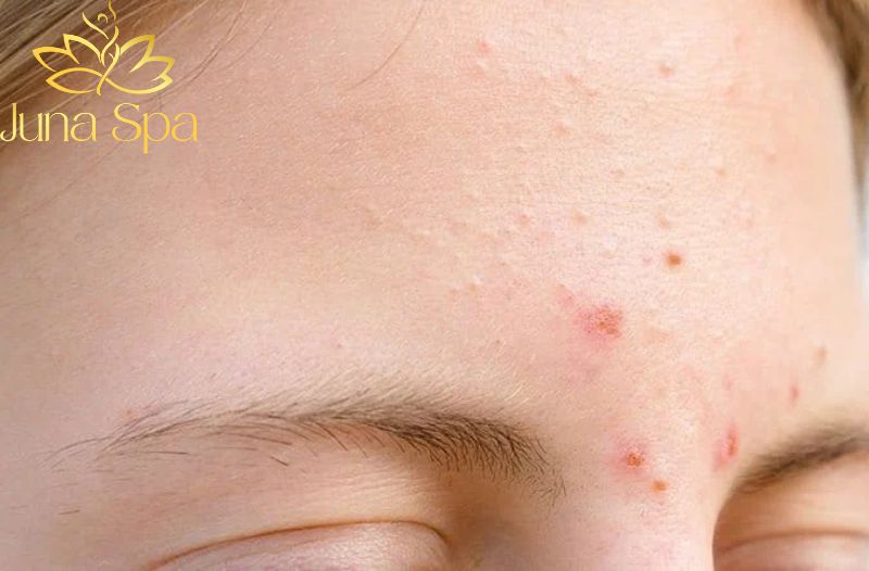 Cách chăm da đúng trong giai đoạn nhạy cảm khi mụn ẩn bùng phát