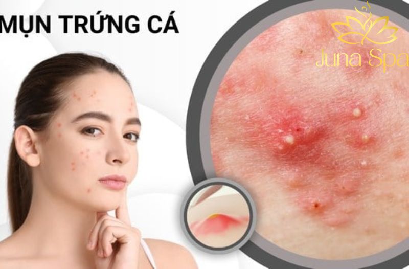 Mụn trứng cá dạng nang không còn là nỗi lo khi bạn biết những điều sau đây
