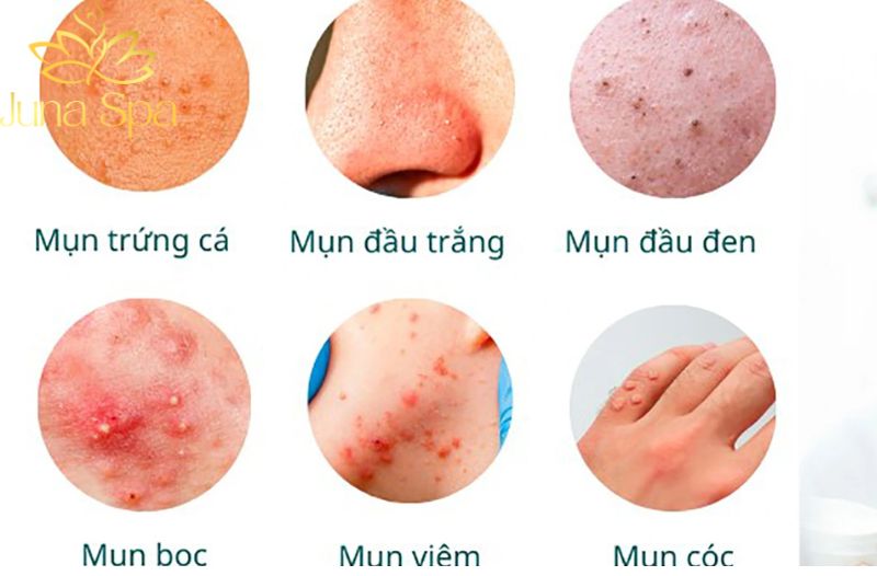 Sự khác nhau của ba loại mụn khi xuất hiện trên trán