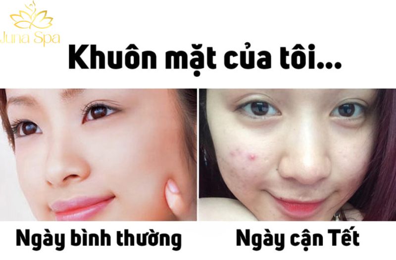 Lấy nhân mụn cận Tết: Nên hay không nên? Dấu hiệu cảnh báo sớm cần chú ý