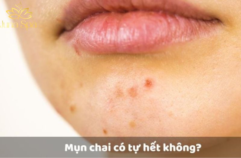 Mụn chai có tự hết không? Giải đáp chi tiết và cách giúp da dần mịn hơn