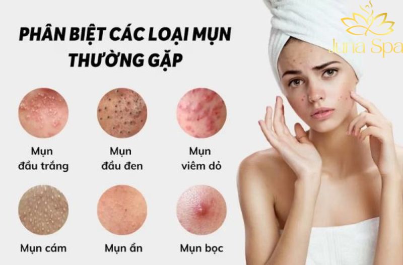 Sự khác nhau về mụn ẩn - Mụn viêm - Mụn đầu đen